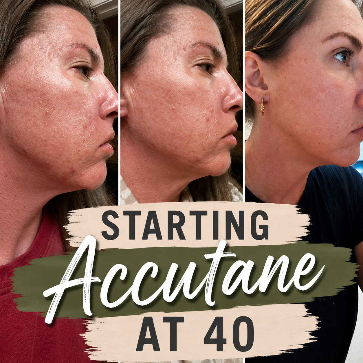 Starting Accutane at 40: Was It Worth It?